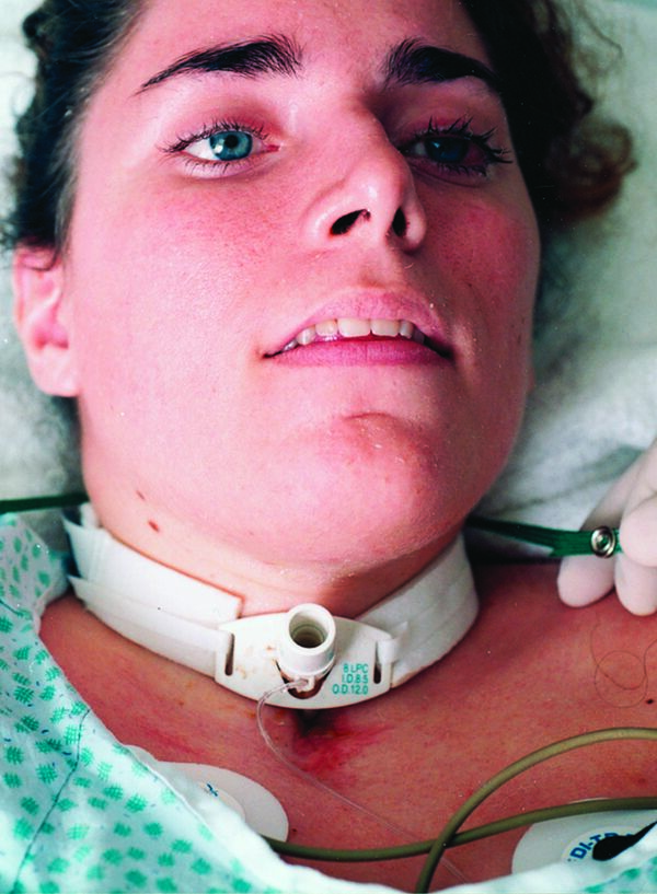 tracheostomy Taber's Medical Dictionary