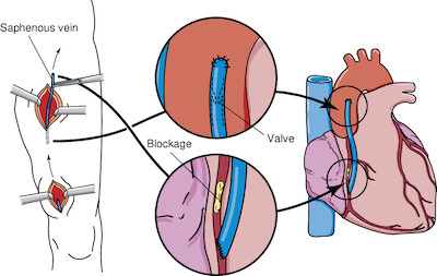Cabg Taber S Medical Dictionary