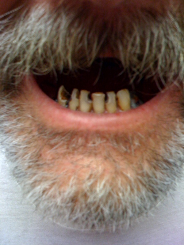 incisor Taber's Medical Dictionary