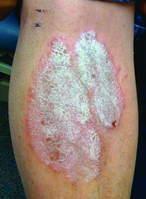 psoriasis Taber's Medical Dictionary